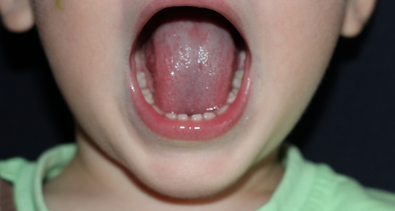 Наша беда с зубками