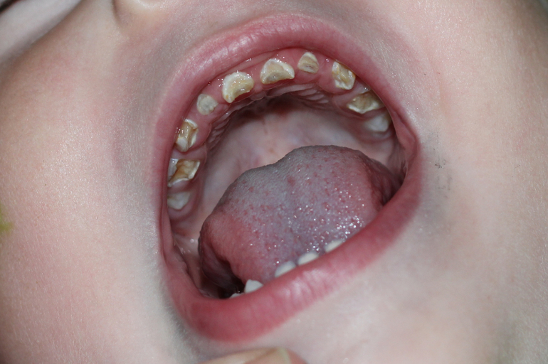 Наша беда с зубками