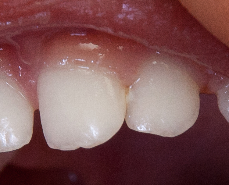 Начинается кариес?