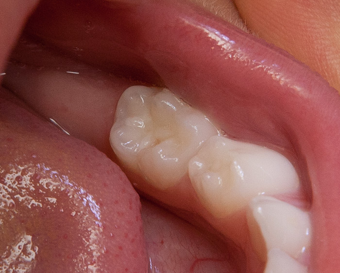 Начинается кариес?