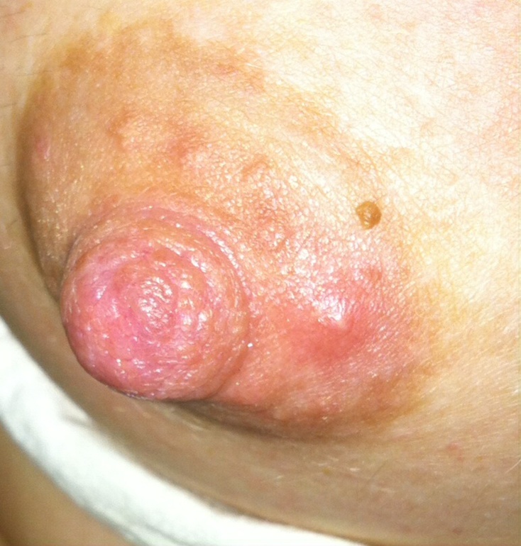 Проблема с ареолой...е