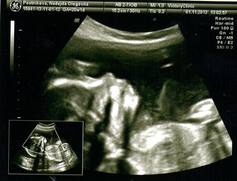 20 недель (Наш экватор + 2 плановое УЗИ)