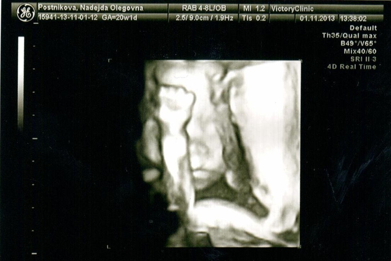 20 недель (Наш экватор + 2 плановое УЗИ)