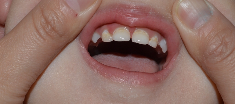 Насколько запущенный кариес?