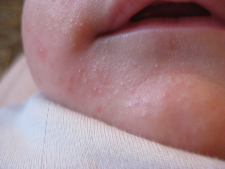 Бледность и цианотичность кожных покровов у ребенка