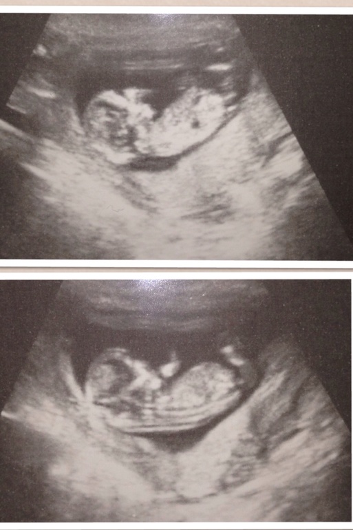 Половой бугорок)