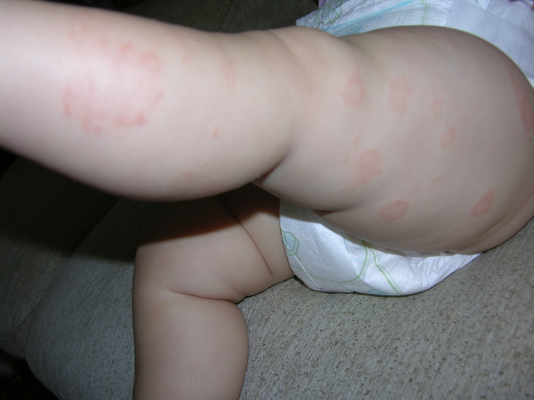 Красные шершавые пятна на ногах у дочки!