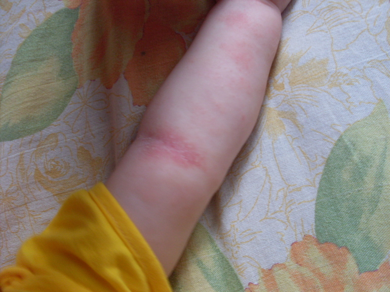 Краснота на коже