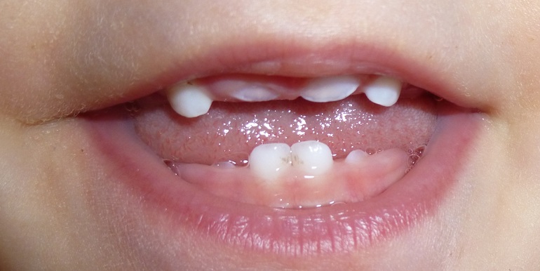 Добрый день!Нам год.Появился темный налет на зубах.Подскажите что это и как избавиться.