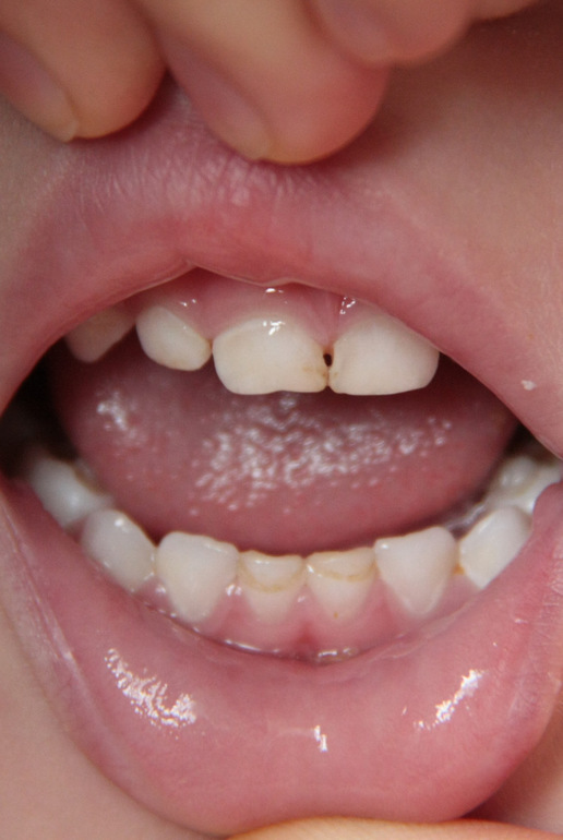 мнения стоматологов разделились!что же делать?