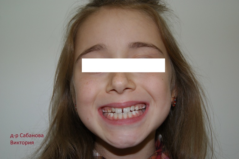 Налет на зубах