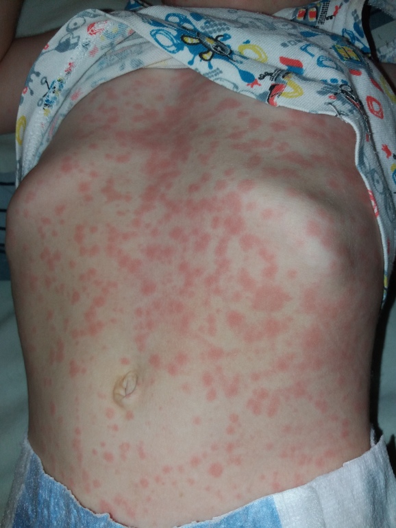 Как выглядят аллергические высыпания?