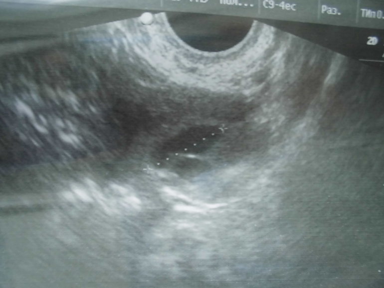 Эндометрий при переносе эмбриона. Эндометрий 8.9 мм фолликул 14 мм. Эндометрия 10мм и желтое тело 16 мм.