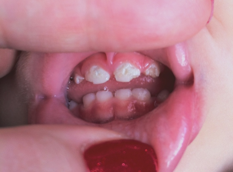 Кариес в 1год и 5 месяцев?((