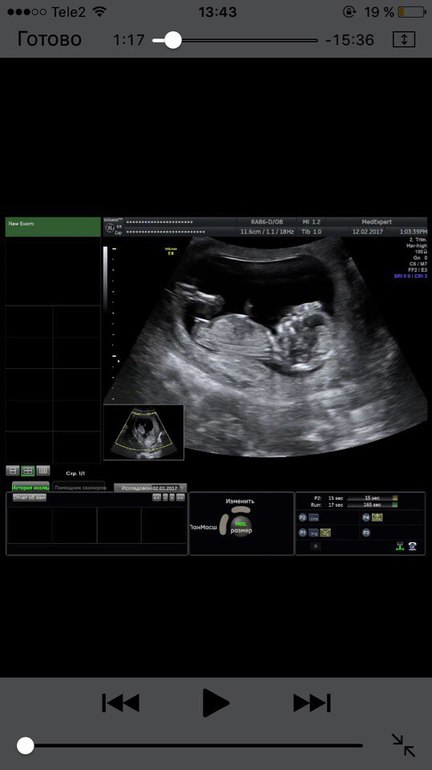 Видео УЗИ. 20 недель беременности. Пол ребенка.