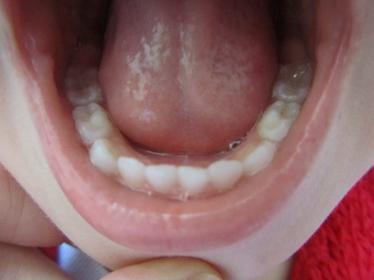 Как вылечить зубки?