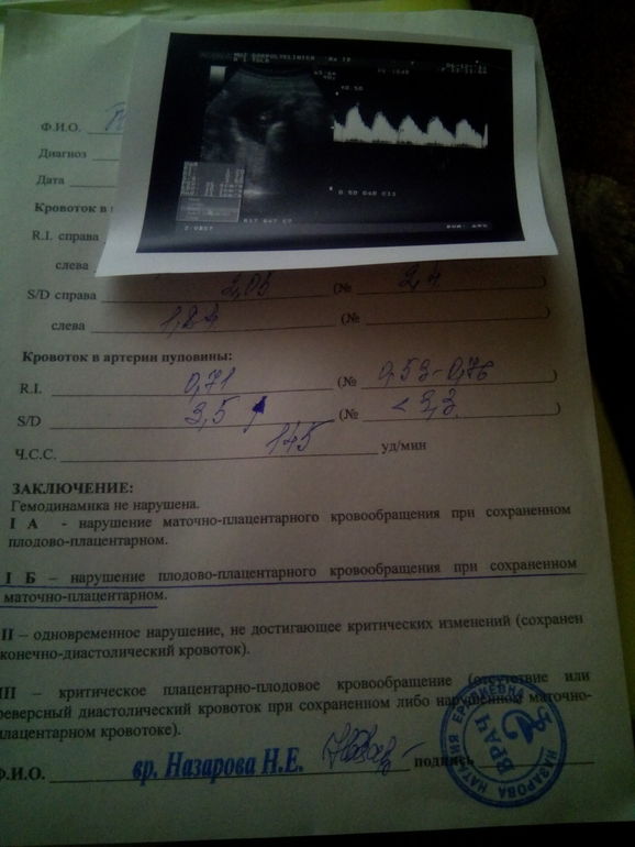 доплер