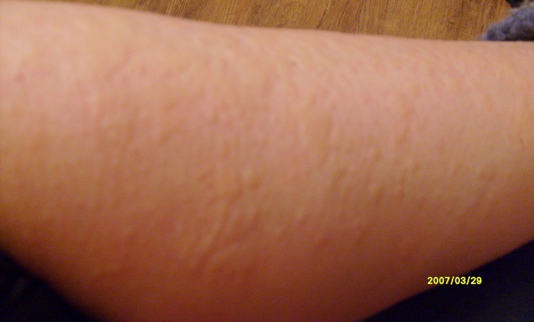 Аллергия. Что делать?