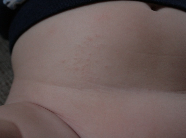 Высыпания. Что это?