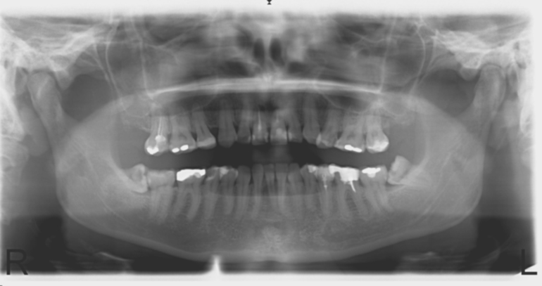 Зубы мудрости