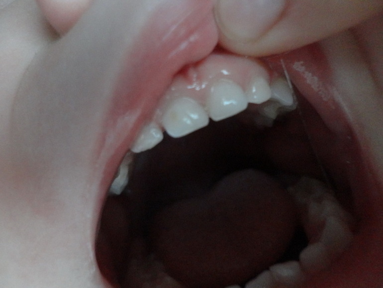 Кариес?!