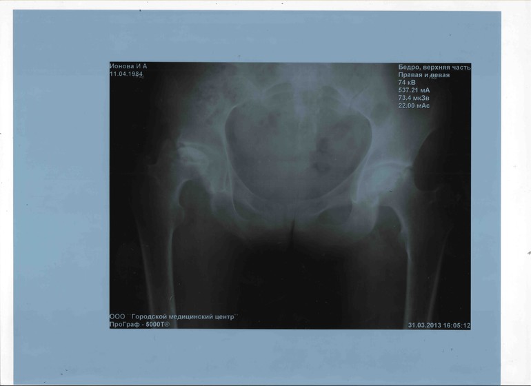 Ирина, 28 лет, собираем средства на тазобедренные эндопротезы