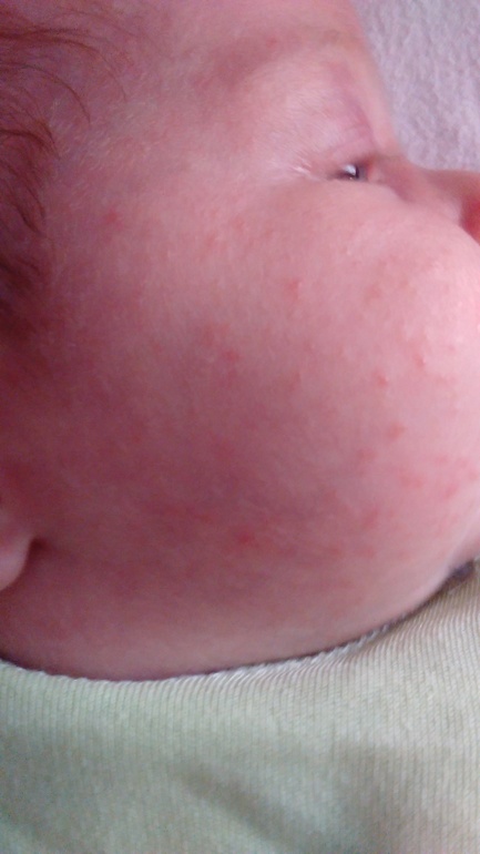 Сыпь на лице у новорожденного: причины появления сыпи на лице, голове и шее, возможное лечение