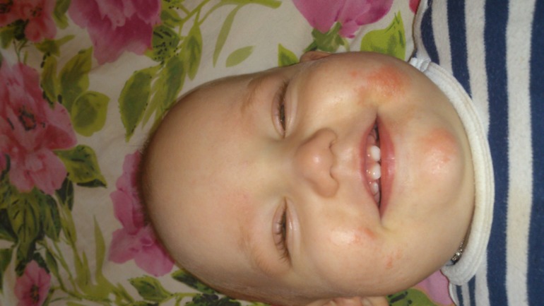 Аллергия или что-то ещё?