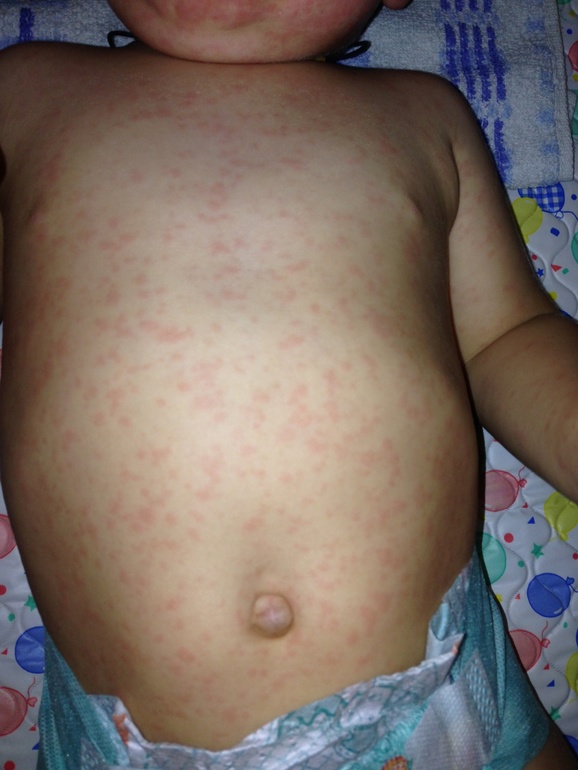 Аллергия на антибиотики – причины и лечение сыпи после антибиотиков