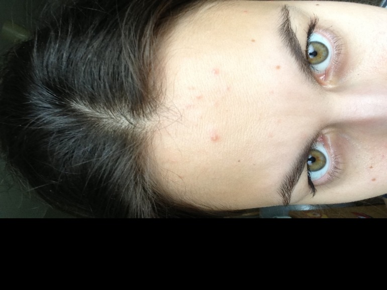 Помогите справиться с прыщами!!я уже не знаю,что мне делать((