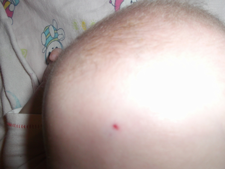 Гемангиома