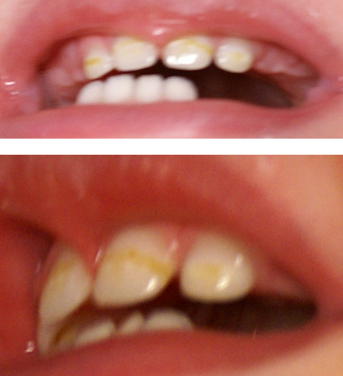 Есть ли шанс спасти зубки?