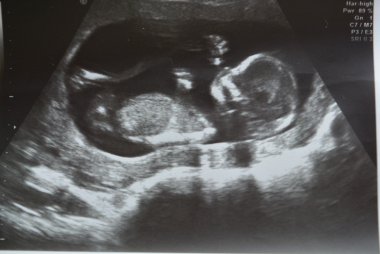 12 неделя беременности от зачатия: УЗИ плода, фото живота, что происходит с мамой и малышом