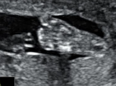 Стоп-кадры УЗИ (из видеоматериала)