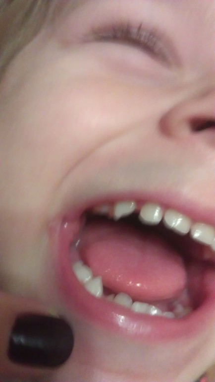 У дочки 2,2 вылез лишний зуб