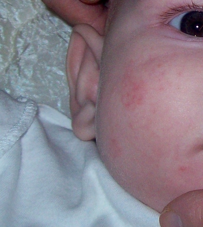 Высыпания на коже