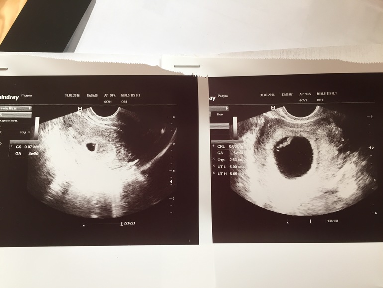 Почему не видно эмбрион. Размер пя в 7 недель беременности.