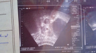 Фото УЗИ на 5 неделе беременности