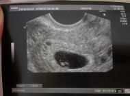 Фото УЗИ на 8 неделе беременности