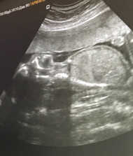 Фото УЗИ на 21 неделе беременности