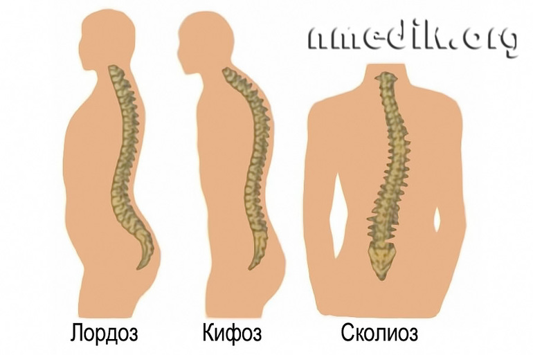 Лордоз (кифоз)(физиологический и патологический) | форум Babyblog