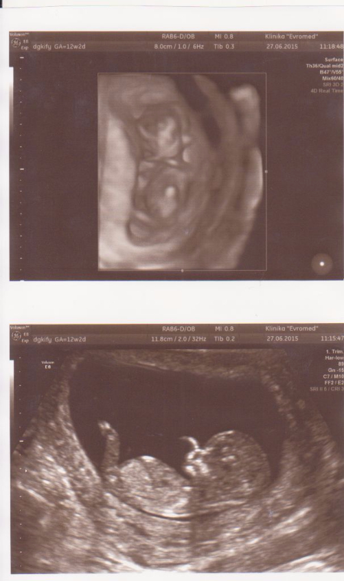 13 акушерская неделя. Снимок УЗИ 13 недель. УЗИ 12-13 недель беременности. УЗИ ребенка 13 акушерских недель. УЗИ 13 недель беременности размер плода.
