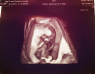 Фото УЗИ на 16 неделе беременности