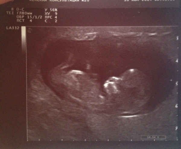 Можно беременность 11 недель. УЗИ 11 недель беременности. Снимок 11 недель беременности. Снимок УЗИ 11 недель беременности.