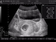 Фото УЗИ на 8 неделе беременности