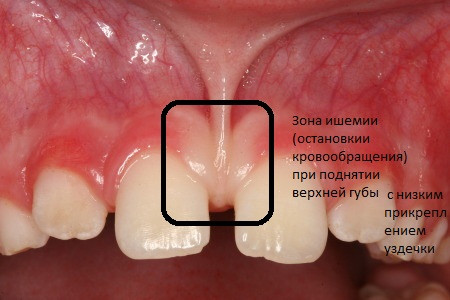 Щели между зубами