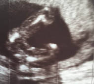 Фото УЗИ на 18 неделе беременности