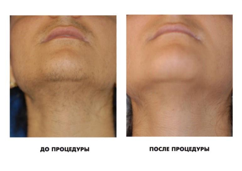 Элос эпиляция в Днепропетровске