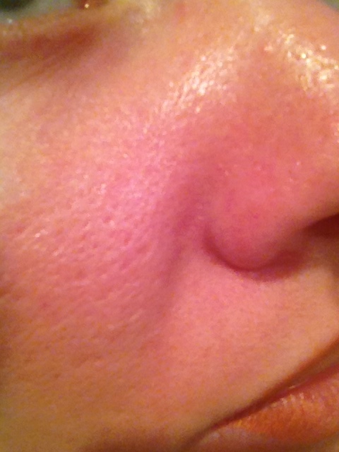 SOS Жирная кожа