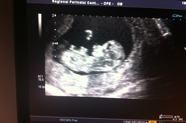 Первый скрининг при беременности 12-13 недель. 11 недель беременности скрининг первый. Снимок скрининга на 13 неделе. Узи 12 недель беременности узи скрининг. Скрининг 11 13 недель.